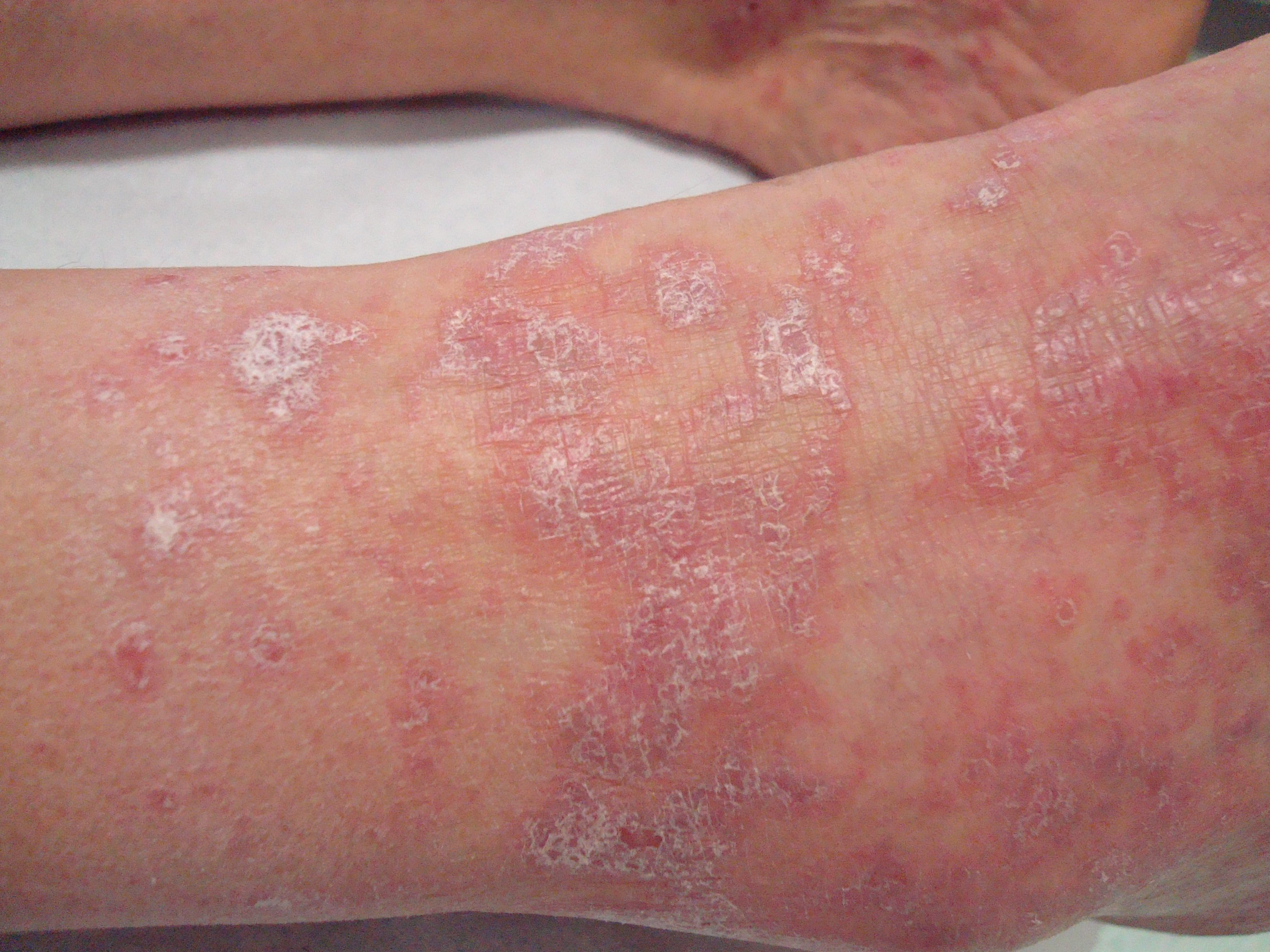 Lichen planus in soggetto con epatite virale C.