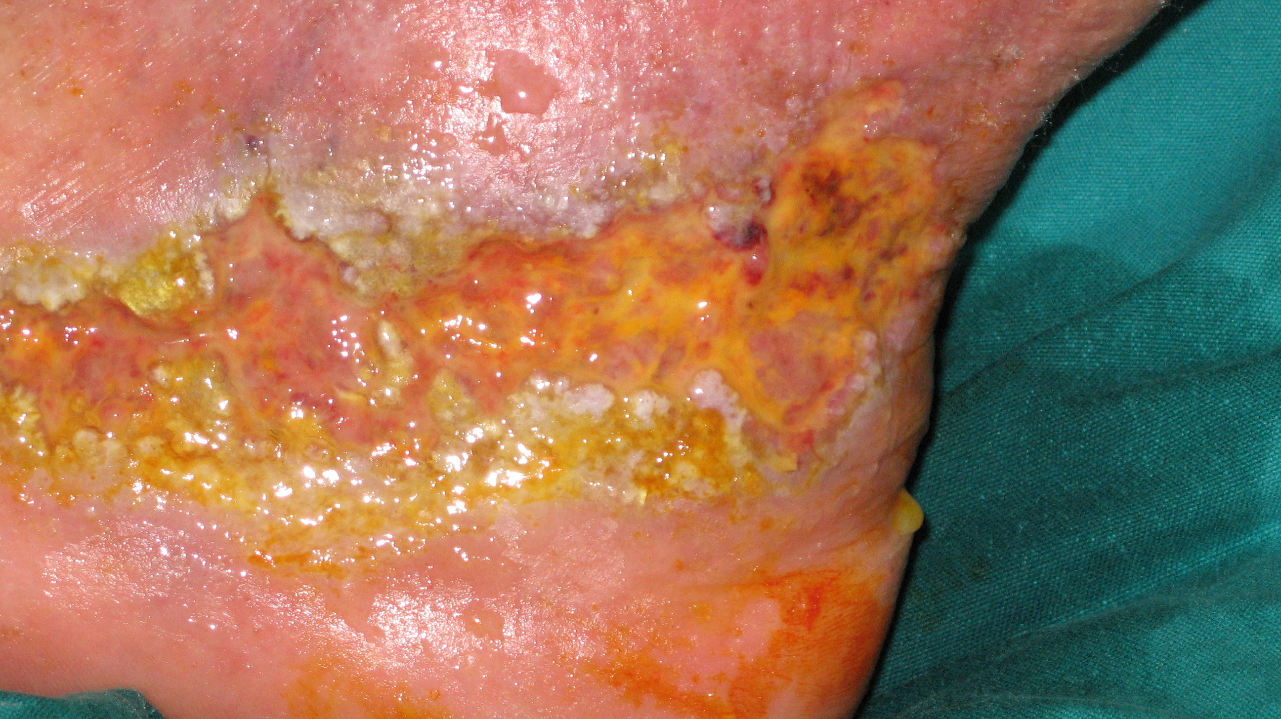 Tipica insorgenza di pioderma gangrenoso in paziente affetta da rettocolite ulcerosa.