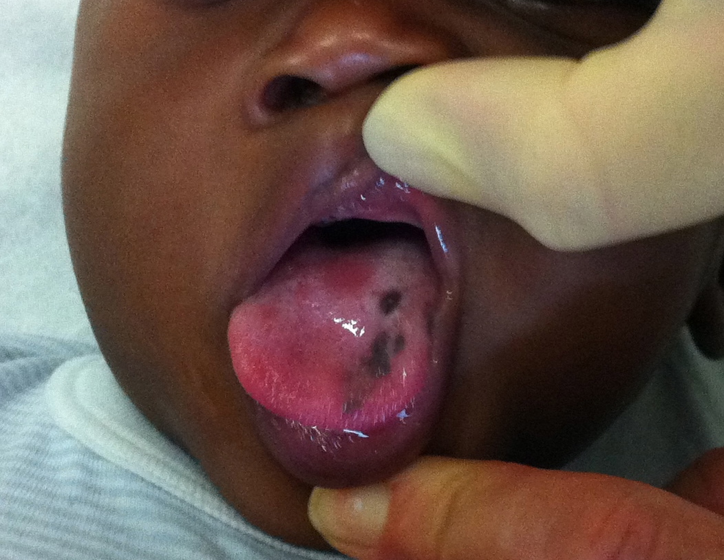 Si tratta delle macule melanotiche congenite della lingua, una rara causa di pigmentazione della mucosa del cavo orale; si tratta di lesioni benigne tipiche dei pazienti di pelle scura; i casi segnalati in letteratura sono molto pochi
