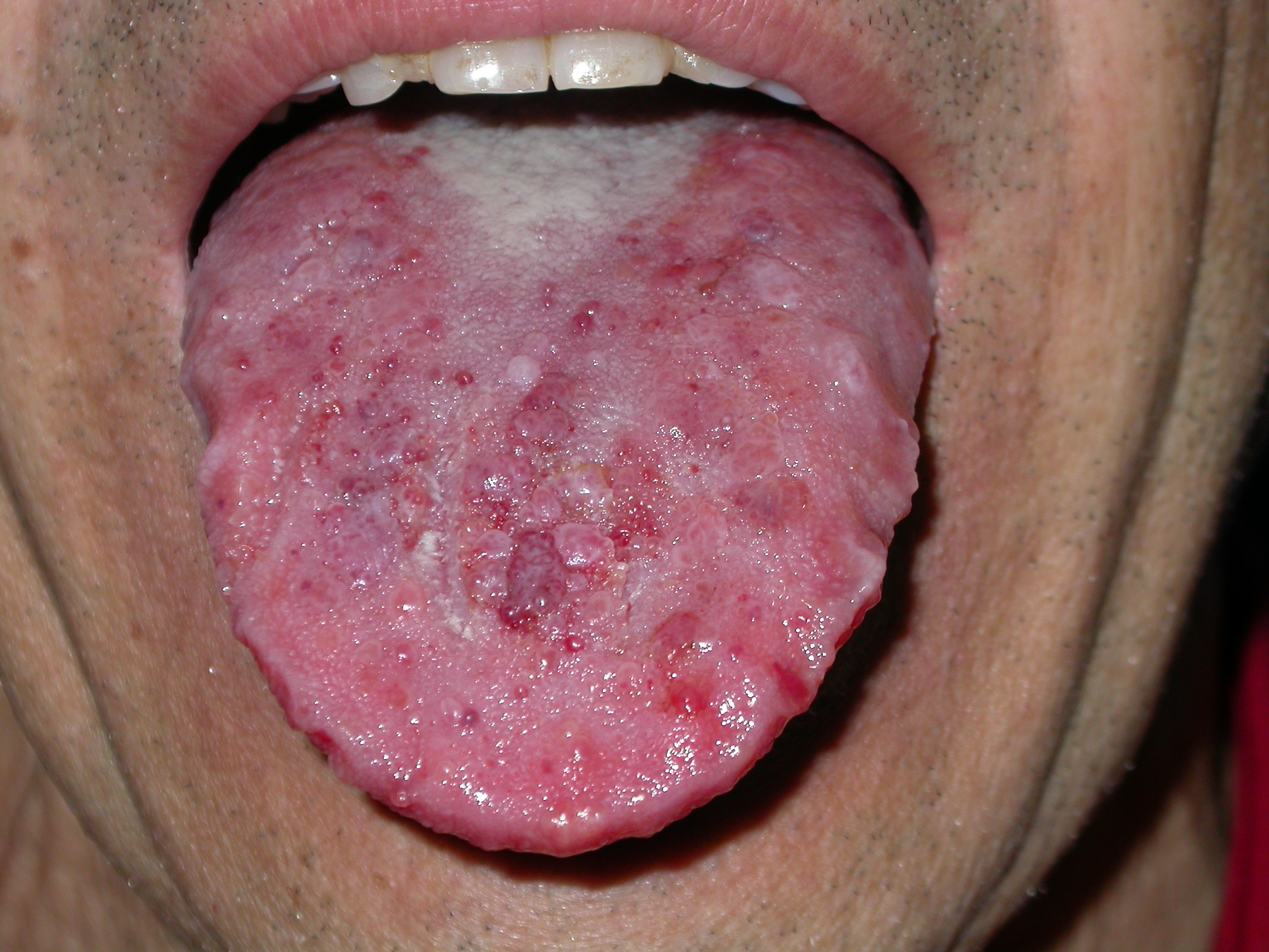Amiloidosi della mucosa linguale