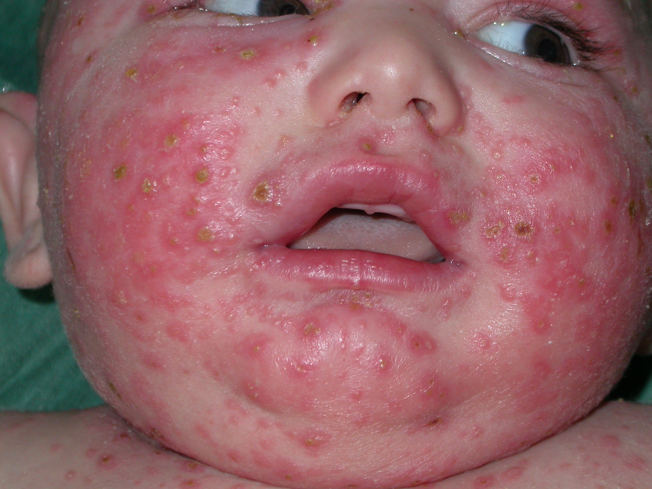 Tipica eruzione varicelliforme di Kaposi in piccolo paziente con dermatite atopica