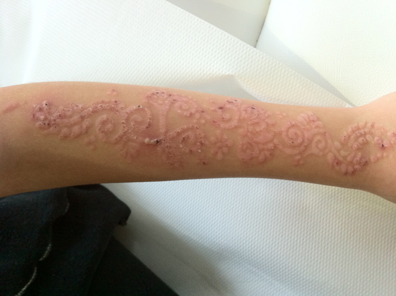 Dermatite da contatto alla parafenilendiamina, utilizzata per aumentare la durata e l'intensita' di colore del tatuaggio all'henne'.