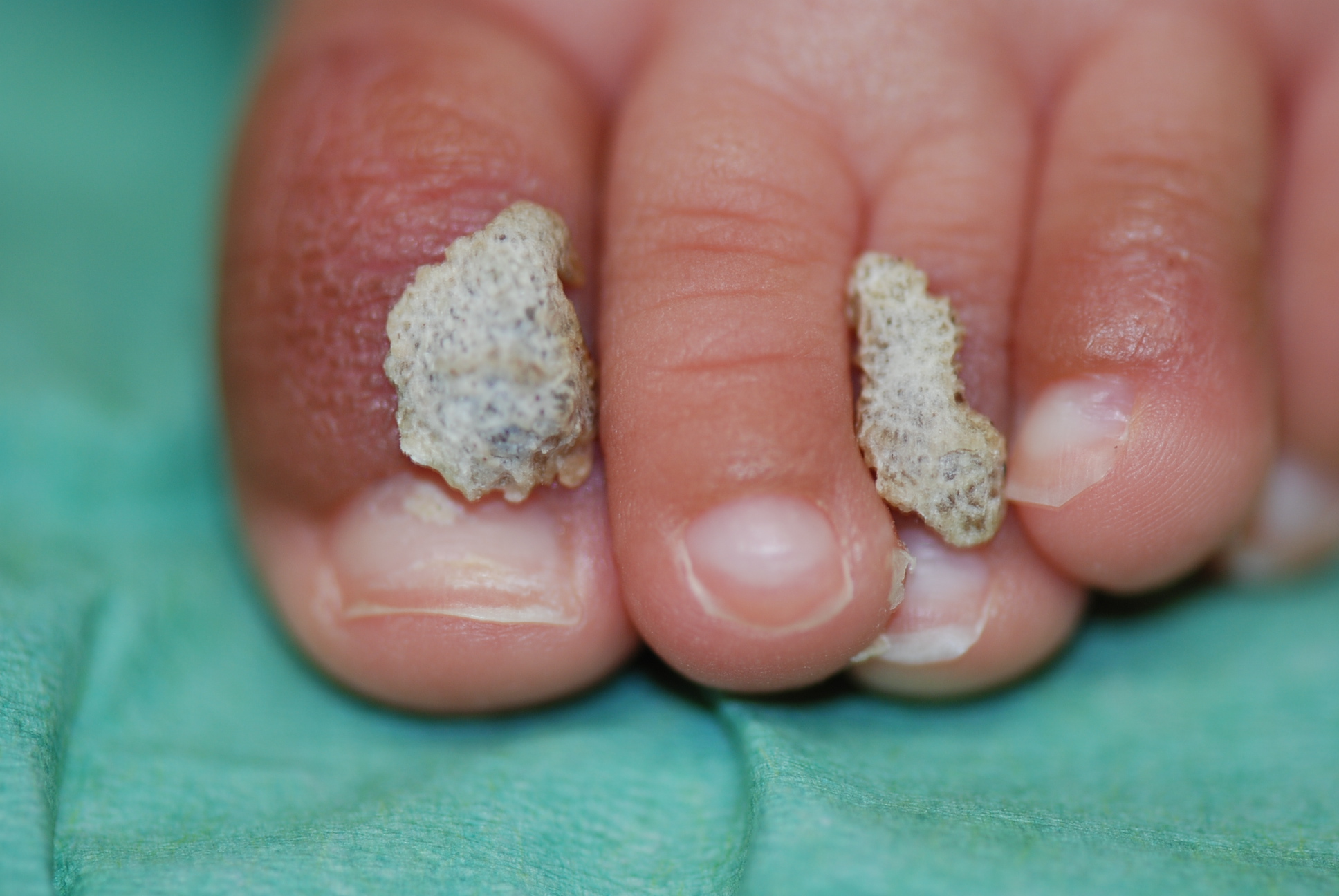 fase papulo-cheratosica dell'incontinetia pigmenti con lesioni verrucose molto pronunciate  alle dita dei piedi